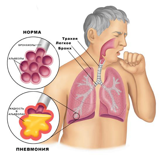 Симптомы и лечение пневмонии: атипичной, вирусной и других форм